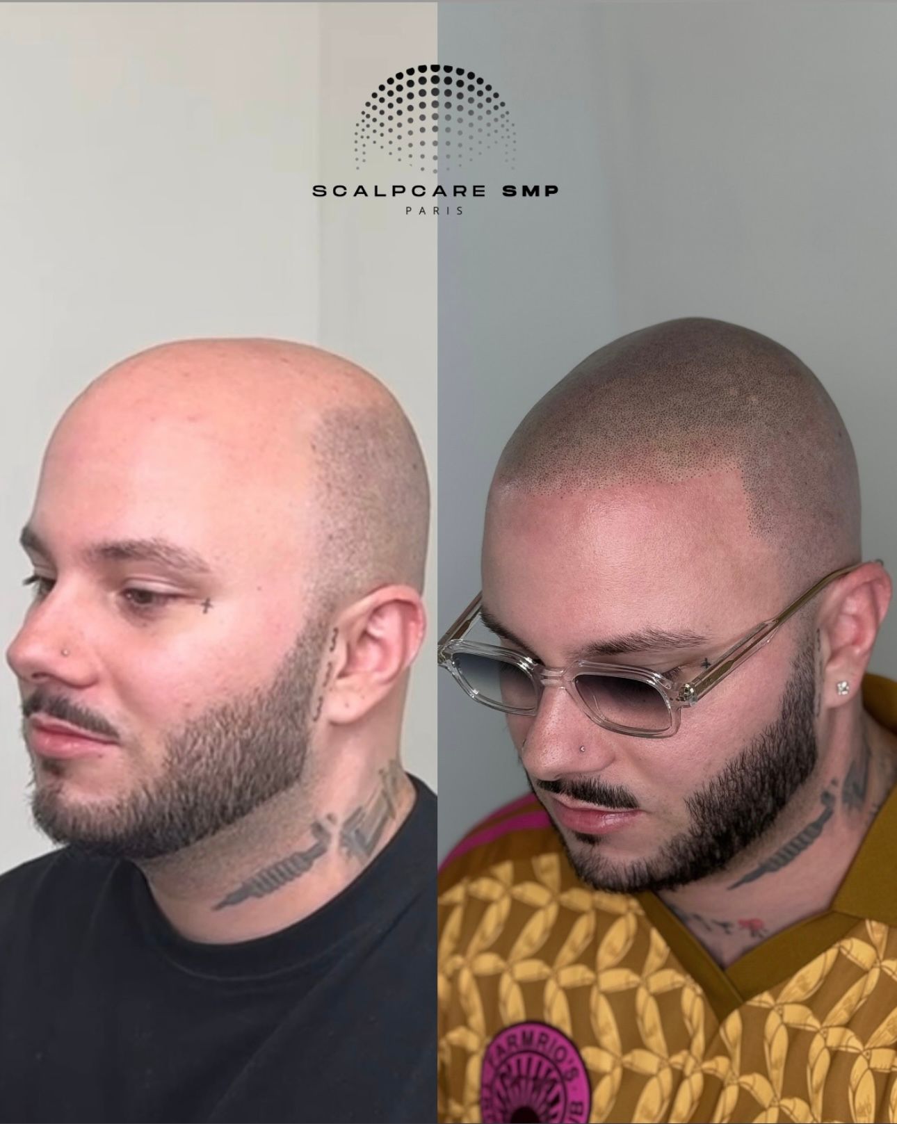 Résultat avant après de micropigmentation capillaire 1