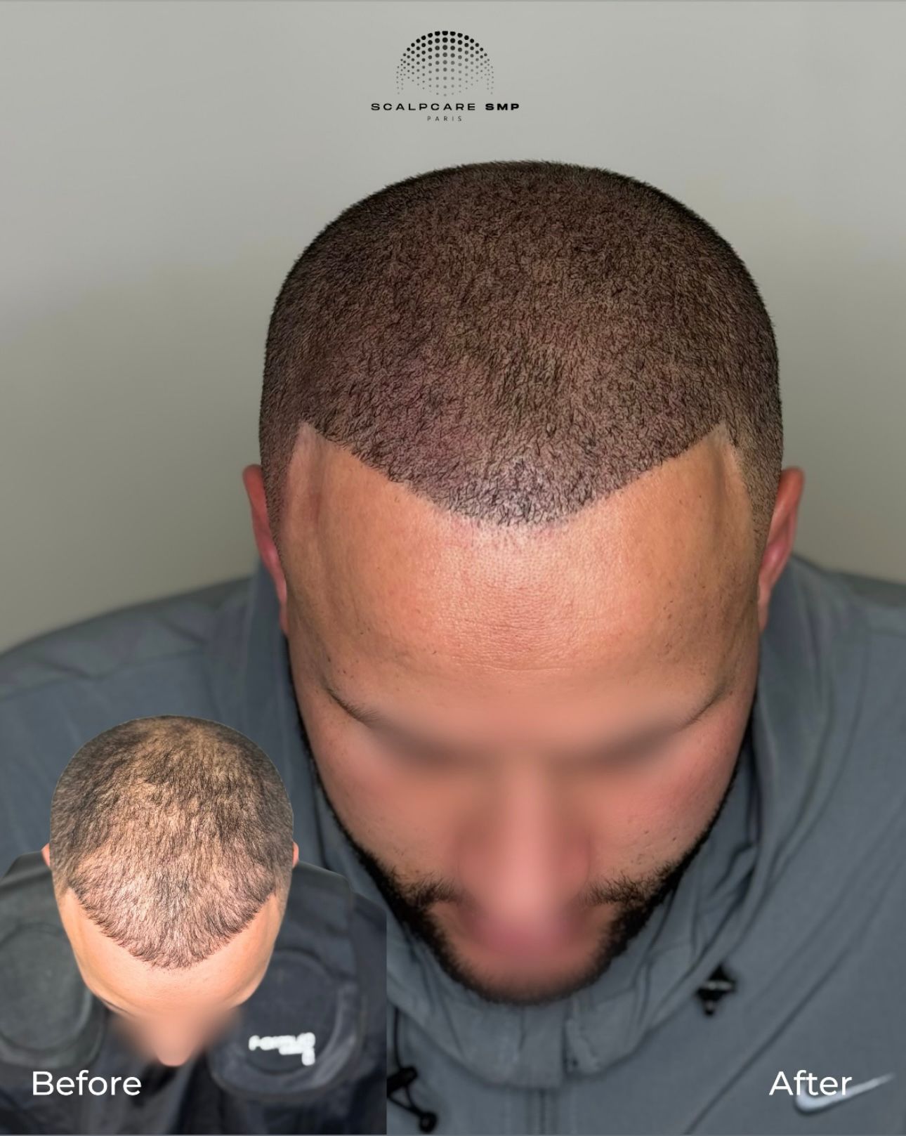 Résultat avant après de micropigmentation capillaire 2