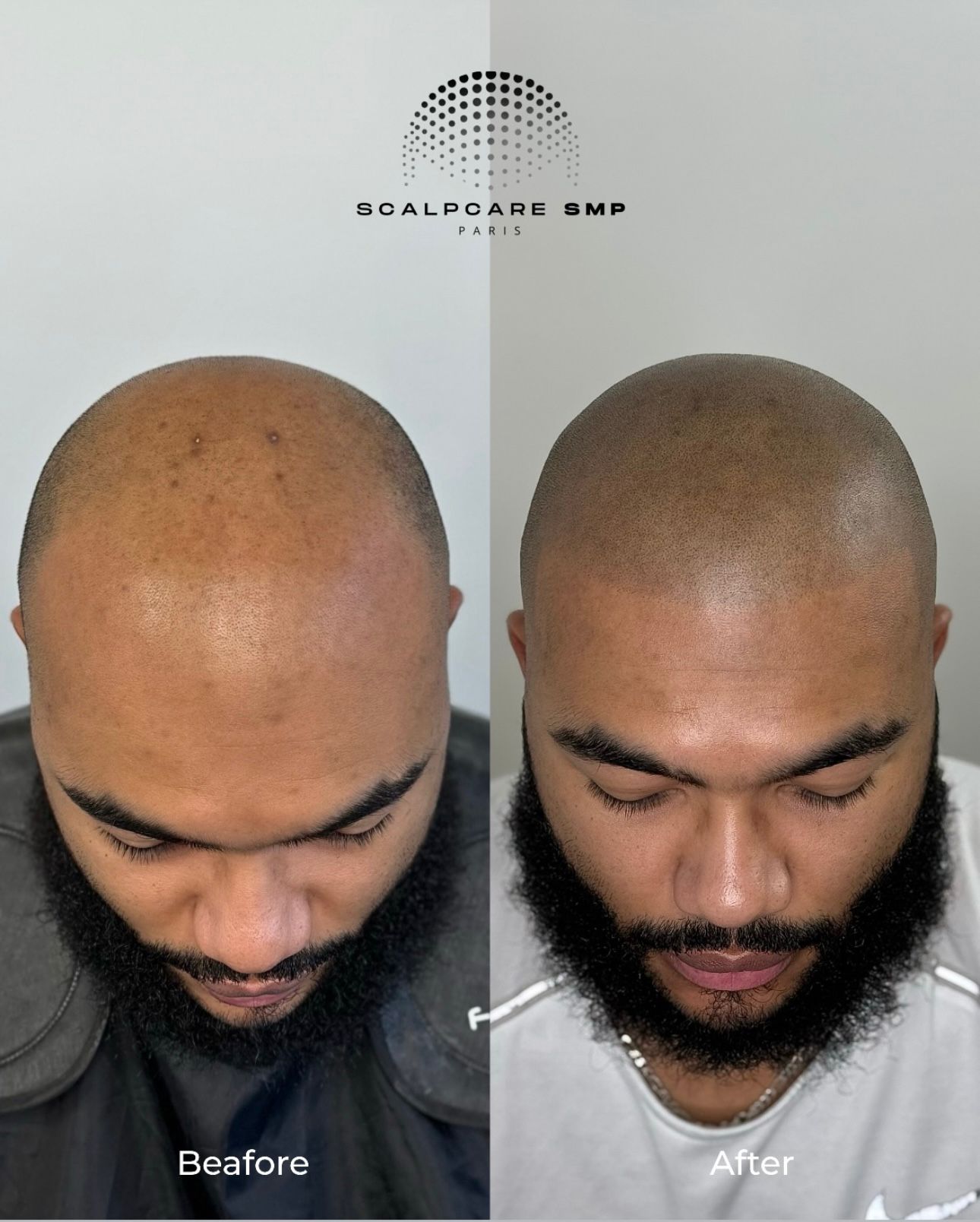 Résultat avant après de micropigmentation capillaire 3