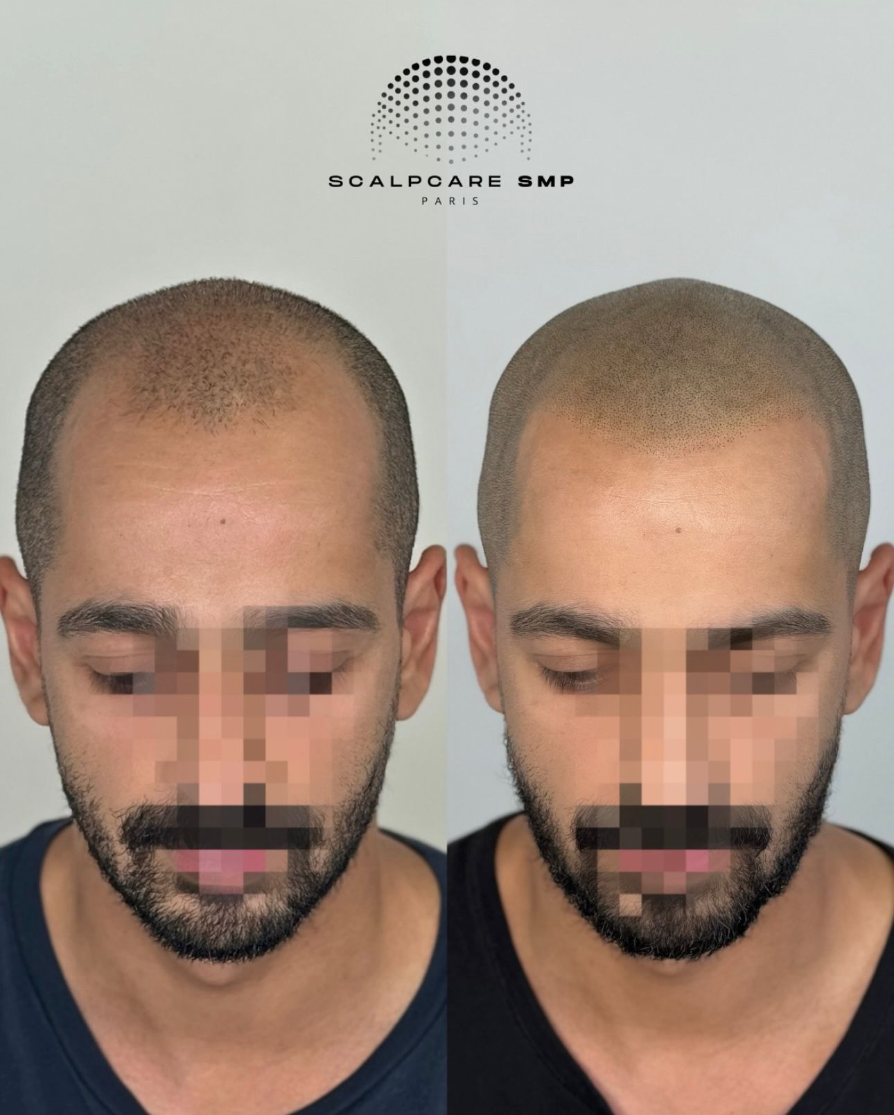 Résultat avant après de micropigmentation capillaire 5