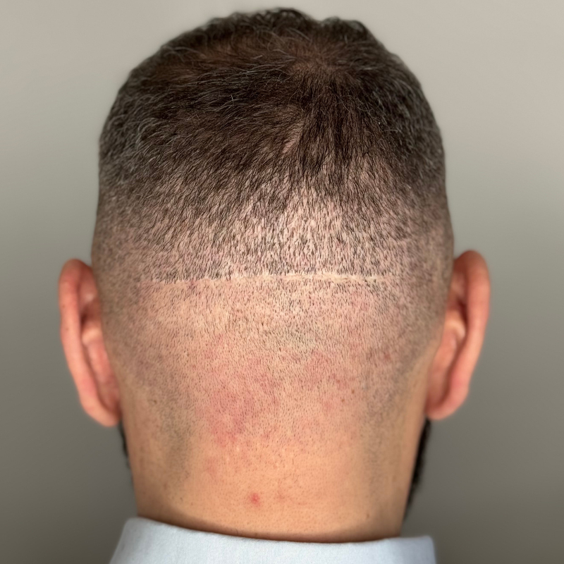 Restauration de cicatrices - micropigmentation capillaire