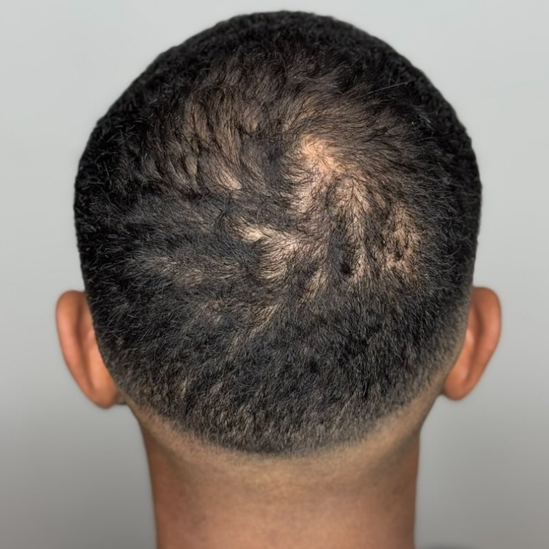 Densification capillaire - micropigmentation